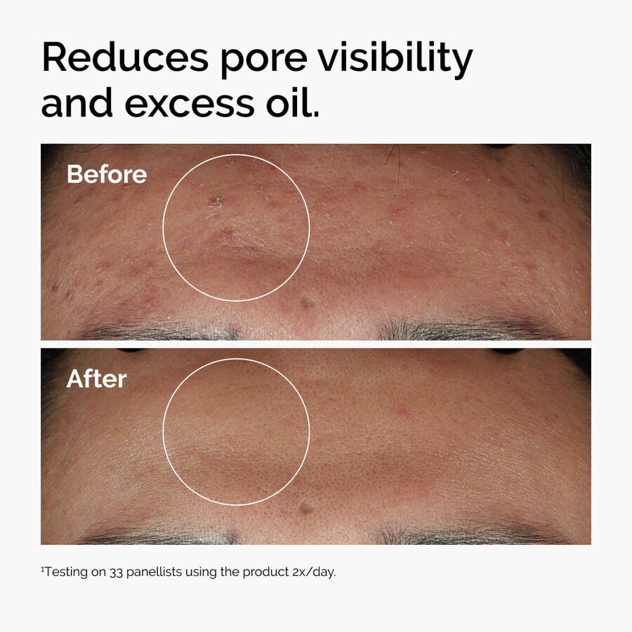 niacinamide-10-zinc-1-a3 ord-niacinamide-zinc-blemish-serum-before-after-pores.jpg