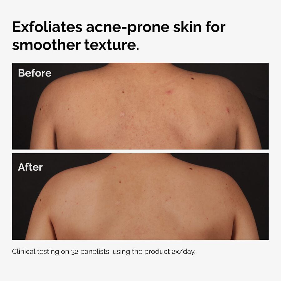 the-body-care-collection-n1 ord-salicylic-acid-body-serum-before-after-graphic-NA.jpg