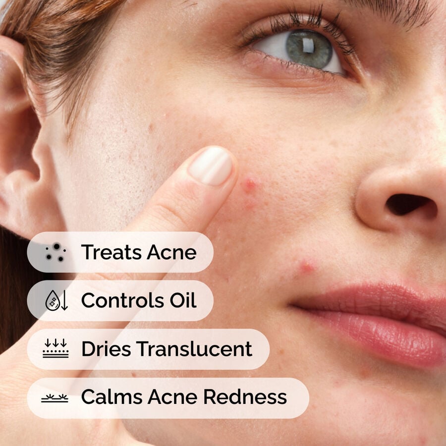sulfur-10-powder-to-cream-concentrate-n8 ord-sulfur-10pct-powder-to-cream-concentrate-model-application-with-benefits-acne.jpg